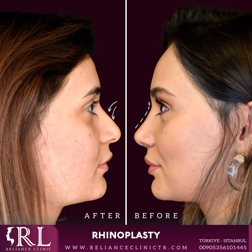 Rhinoplasty 1