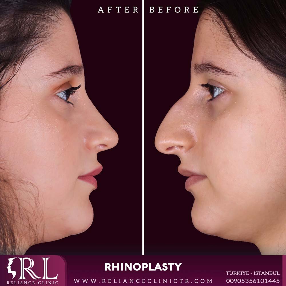 Rhinoplasty 3