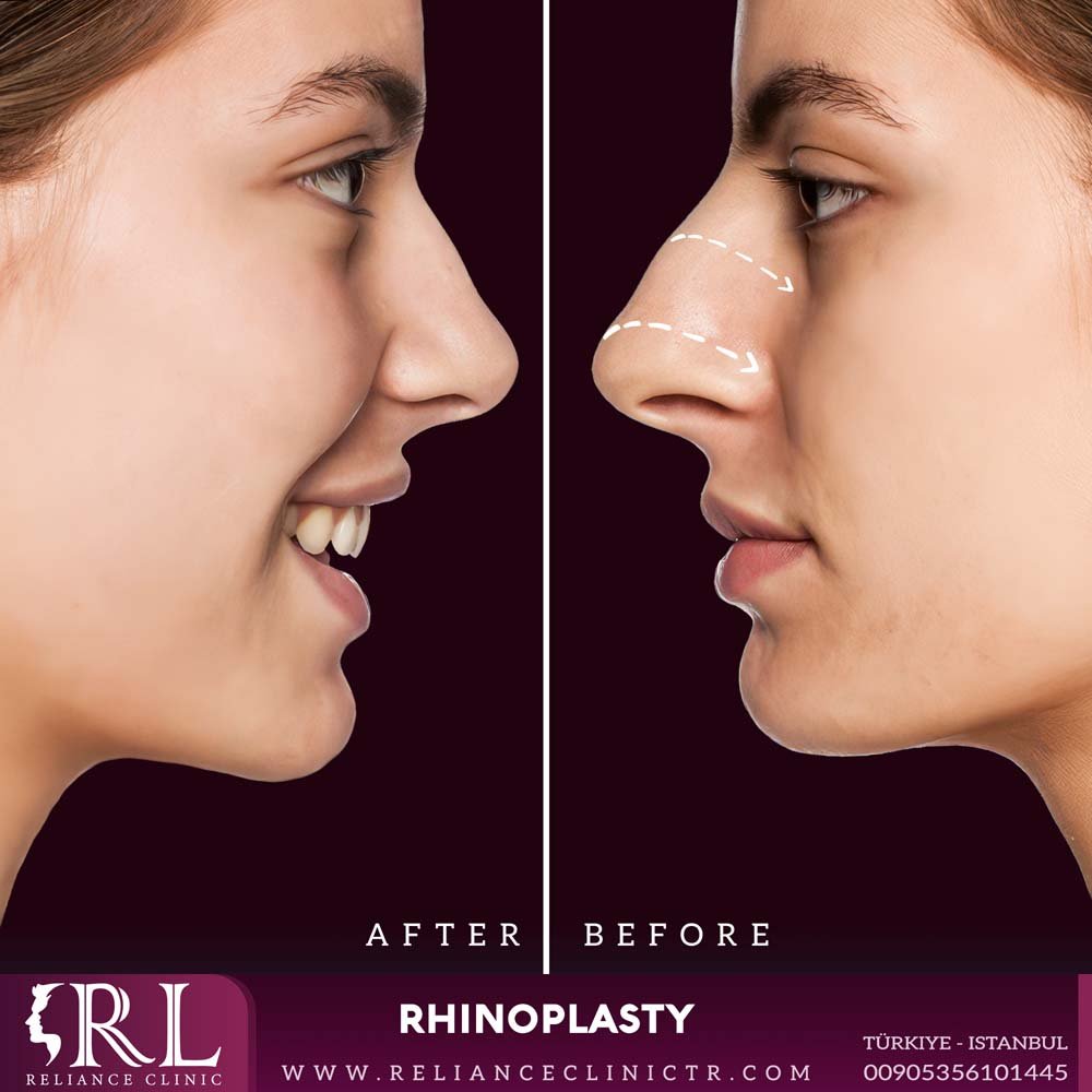 Rhinoplasty