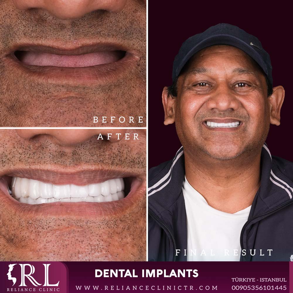 dental implants 211