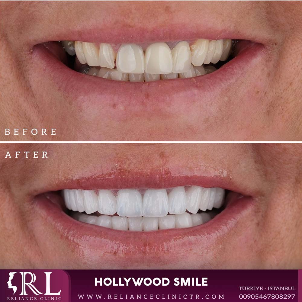 hollywood smile 13