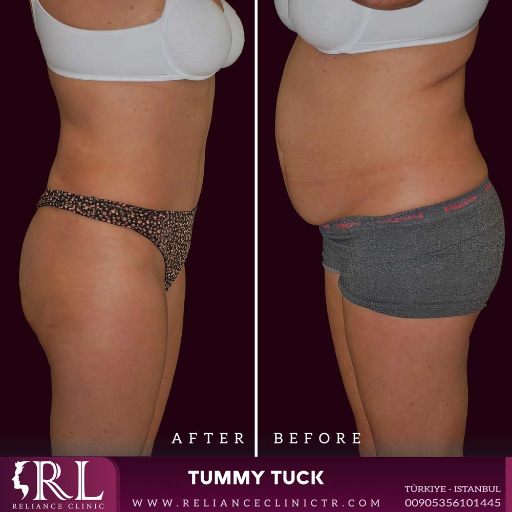 tummy tuck